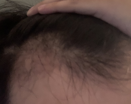 植髮-三個月-術後-過程-分享