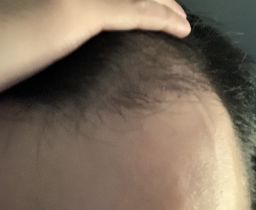植髮-三個月-過程-經驗-歷程-分享
