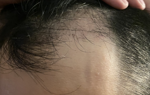 植髮-手術-一個月-右側