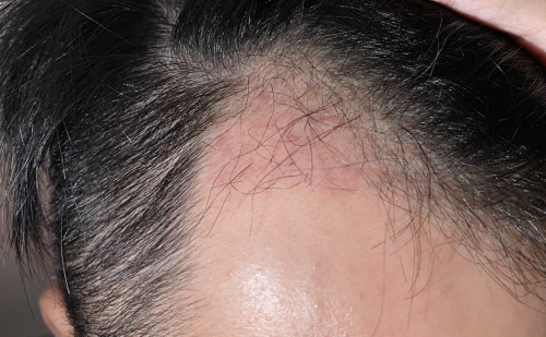 植髮-手術-一個月-左側