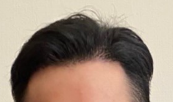 植髮手術-九個月-油頭-造型