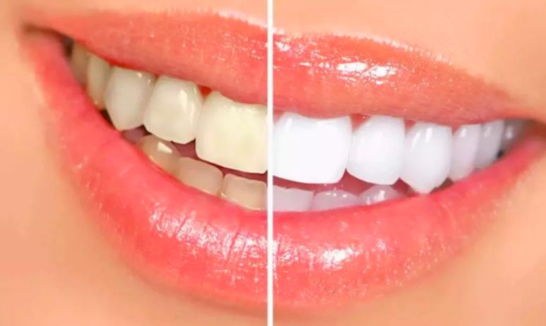 美白-牙齒-變白-方法-分享-教學-diy